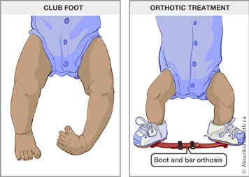 Baby with clubfoot and baby wearing boot and bar orthosis