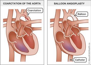 Illustration of coarctation of the aorta and of balloon angioplasty