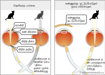 மங்கிய பார்வையுள்ள கண்ணின் பார்வையை நல்ல கண்ணை மூடிக் கட்டியதால் திருத்தப்பட்ட பார்வையுடன் ஒப்பிடல்