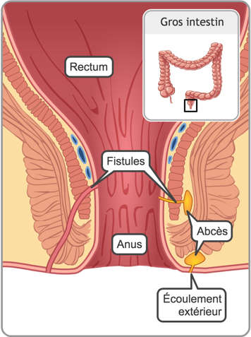 Rectum et anus avec fistules et abcès