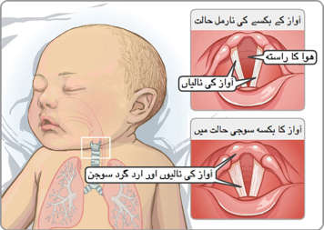 نارمل حنجرہ اور صوتی ڈوریوں اور سوجی ہوئی صوتی ڈوریوں کے ساتھ متورم حنجرہ اور اردگردکی بناوٹیں