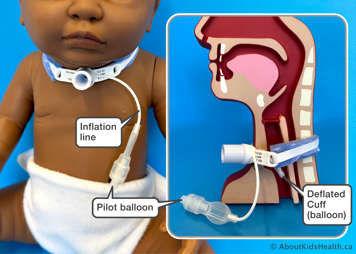 Cuffed tracheostomy tube outside and inside the body, showing cuff deflated in the airway