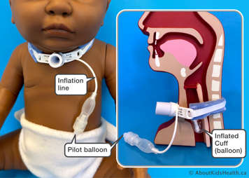 Cuffed tracheostomy tube outside and inside the body, showing cuff inflated in the airway