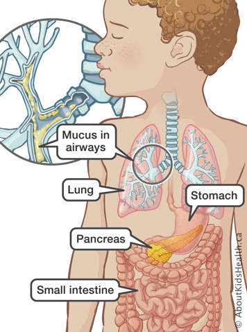 Stomach, pancreas, small intestine and lung identified in upper body of a child, with a close-up showing mucus in the airways