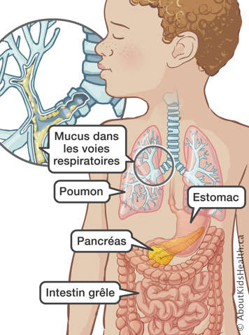 Poumon, estomac, pancréas et intestin grêle dans un enfant, et une illustration du mucus dans les voies respiratoires