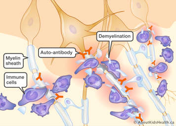 Immunce cells attacking the myelin shealth of neurons