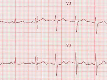 Modèle d'un électrocardiogramme