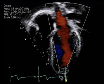 Echocardiogram