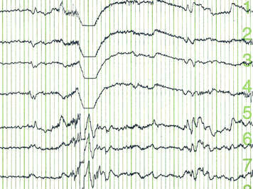 Traçado indicado no eletroencefalograma (EEG)