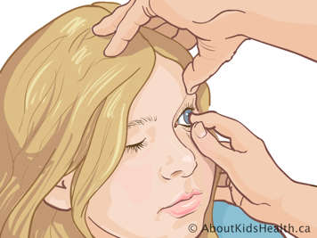 Holding first finger on the eye and thumb on the lower eyelid, while holding the upper eyelid open with the other hand