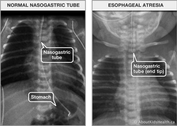 Normal nasogastric tube x-ray and esophageal atresia x-ray