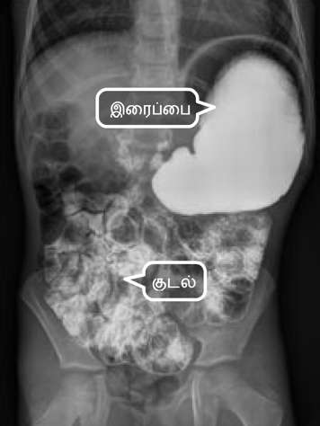 வயிறு மற்றும் சிறுகுடலின் கதிரியக்கப்படம்  X-ray