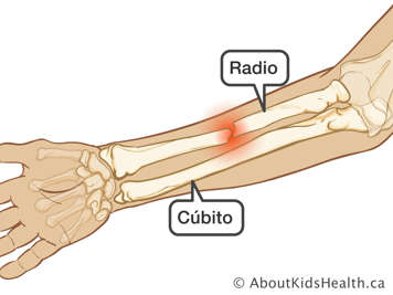 Antebrazo con una fractura de radio