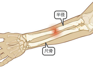 前臂桡骨骨折