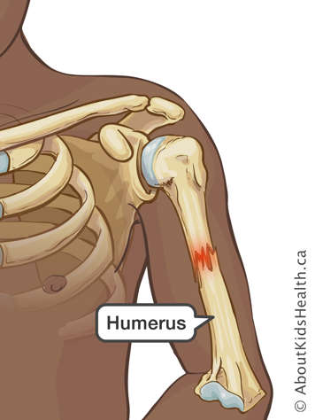 Fracture in the middle of the upper arm