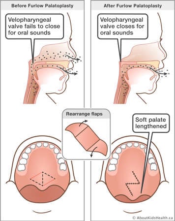 Furlow palatoplasty showing how the soft palate is lengthened