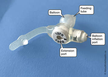 mic-key tube showing balloon, balloon inflation port and extension port