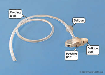 low-profile GJ tube showing balloon, balloon port, and feeding port