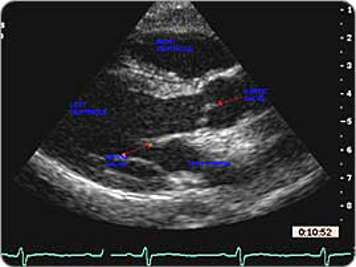 Ecocardiograma