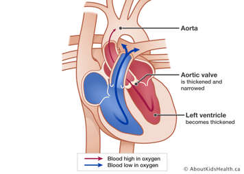 Heart with an aortic stenosis where aorta delivers less blood to body and aortic valve is narrow