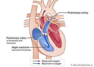 Heart with thickened and narrowed pulmonary valve and thickened right ventricle