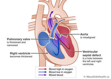 Heart with thickened and narrowed pulmonary valve, thickened right ventricle, misaligned aorta and a hole between the left and right ventricles