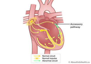 Accessory pathway from left atrium to Purkinje fibers causes abnormal circuit next to normal circuit in Purkinje fibers.