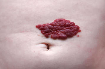 Red, raised birthmark that looks like a strawberry on a baby's belly, just above the belly button