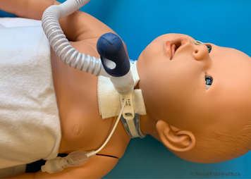 Heated breathing tube is connected to child's tracheostomy