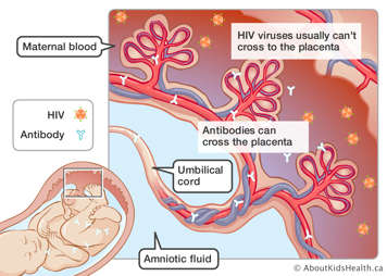 HIV viruses in placenta and antibodies in placenta, umbilical cord and baby