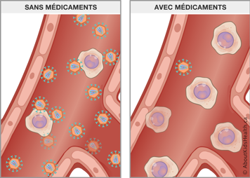 Plusieurs copies de VIH dans le sang sans médicaments et seulement une copie de VIH dans le sang avec médicaments