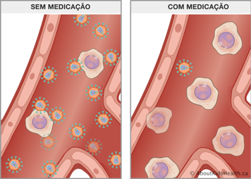 Diversas células infetadas pelo VIH em sangue não medicado e apenas uma célula infetada por VIH em sangue medicado