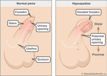 Identification of the meatus (opening), foreskin, glans, urethra and scrotum in a normal penis and a penis with hypospadias