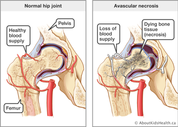 Hip joint with avascular necrosis—a loss of blood supply to vessels at the hip joint and grey, dying bone tissue in the hip