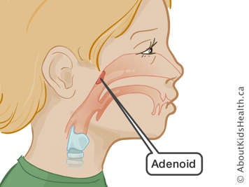 Location of adenoid