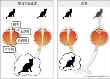 弱視示意圖：從右眼看到的貓非常清晰，而左眼看到的貓是模糊的