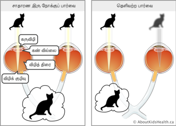வலது கண்ணில் பூனை ஒன்றின் மங்கலான விம்பம் மற்றும் இட து கண்ணில் பூனை ஒன்றின் தெளிவான விம்பம் மூலம் மங்கலான பார்வை விளங்கப்படுத்தப்பட்டுள்ளது