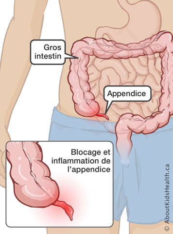 Identification du gros intestin et de l'appendice et une représentation d'un appendice avec un blocage et de l'inflammation