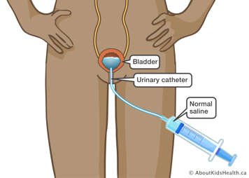 bladder filled with water and normal saline solution