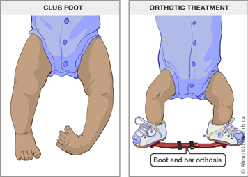 Baby with clubfoot and baby wearing boot and bar orthosis