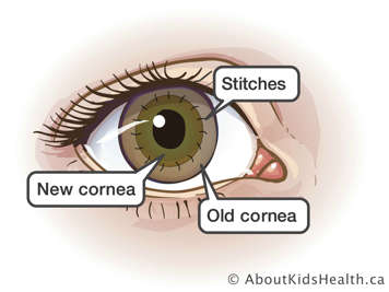 An eye with a new cornea and old cornea held together with stitches