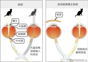弱視視力與戴眼罩矯正後視力的比較