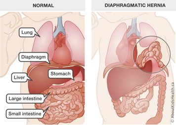 Baby with normal lung, diaphragm, liver, stomach, and small and large intestines, and a baby with lower organs in the chest