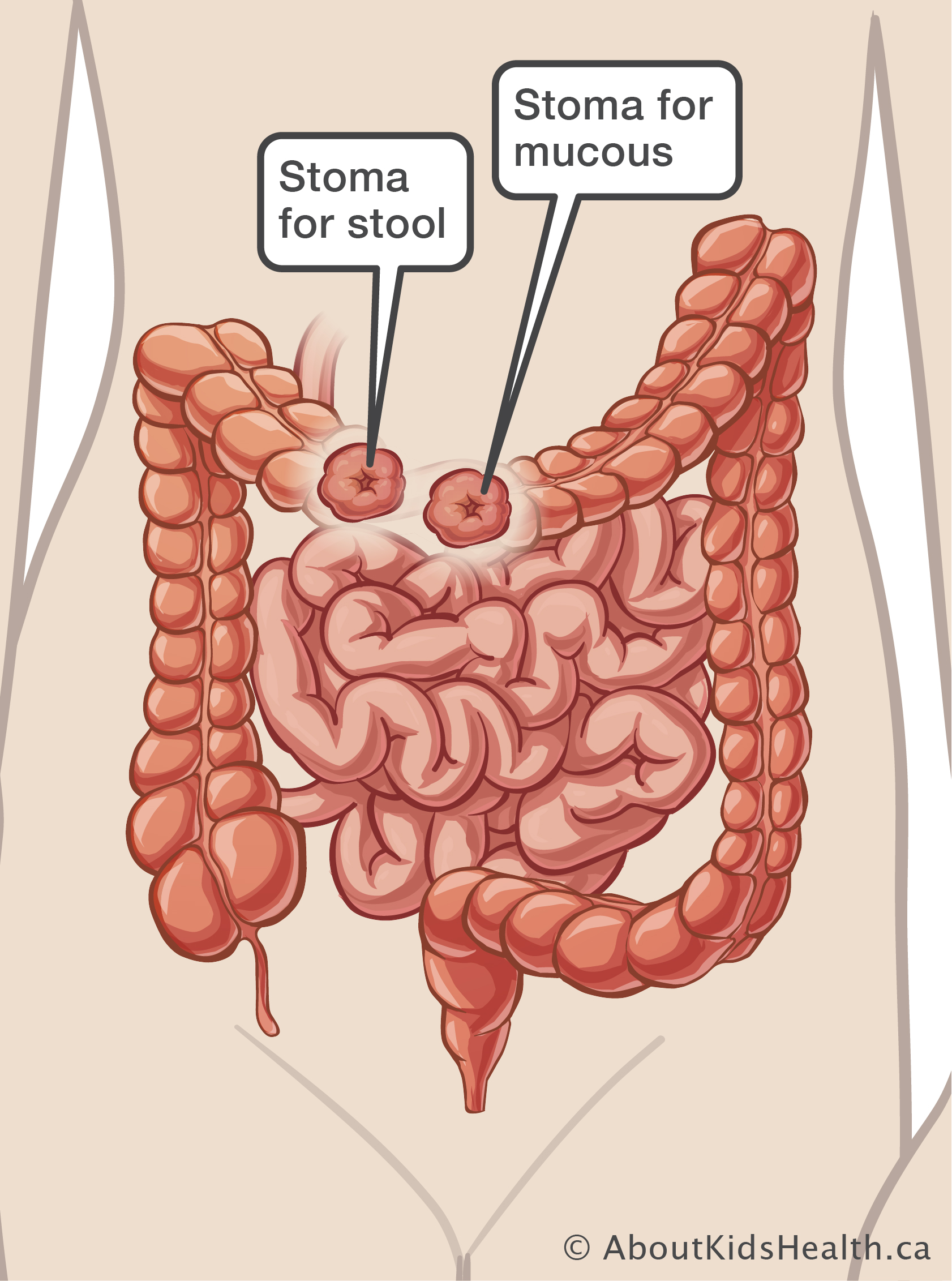 Medical illustration of double-barrel ostomy which has two ends of bowel outside the abdomen to drain stool and mucous
