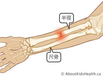 前臂橈骨骨折