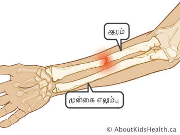 ஆரை எலும்பு உடைந்த முன்கை