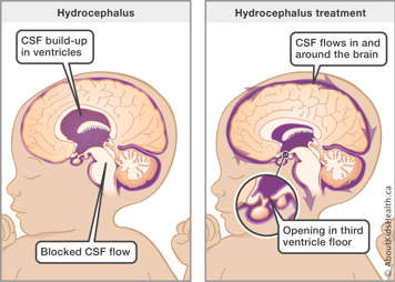 Side-by-side view of hydrocephalus and ETV surgery, which creates an opening in the third ventricle