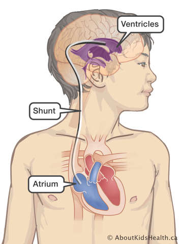 A shunt through the ventricles in the brain leading to the heart