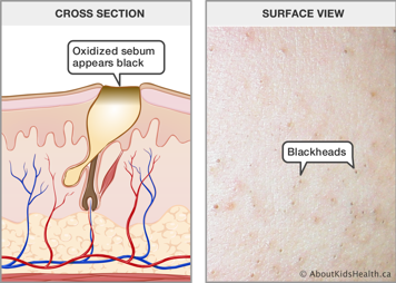 Cross section of skin with an oxidized sebum, which appears black at the top, and a surface view of skin with blackheads