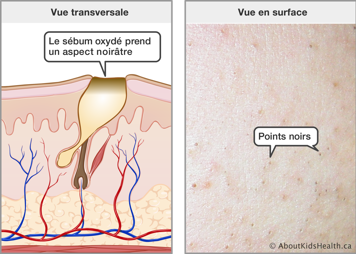 Vue transversale de la peau avec un sébum oxydé causant un aspect noirâtre à la surface et la vue en surface des points noirs